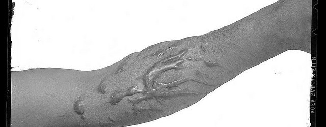 What is a Keloid Scar?