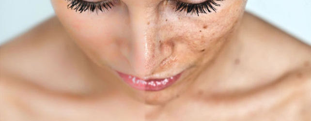 Melasma Treatment: How to Fade Hyperpigmentation