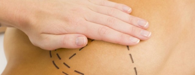 What is Breast Reduction Surgery?