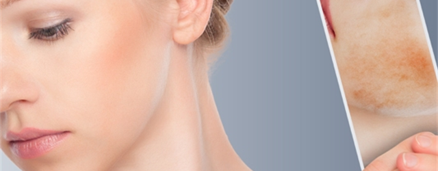 What is Facial Scar Revision?