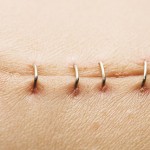 Get Rid of Hysterectomy Scars