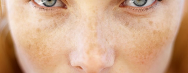 What is the Difference Between Freckles and Age Spots